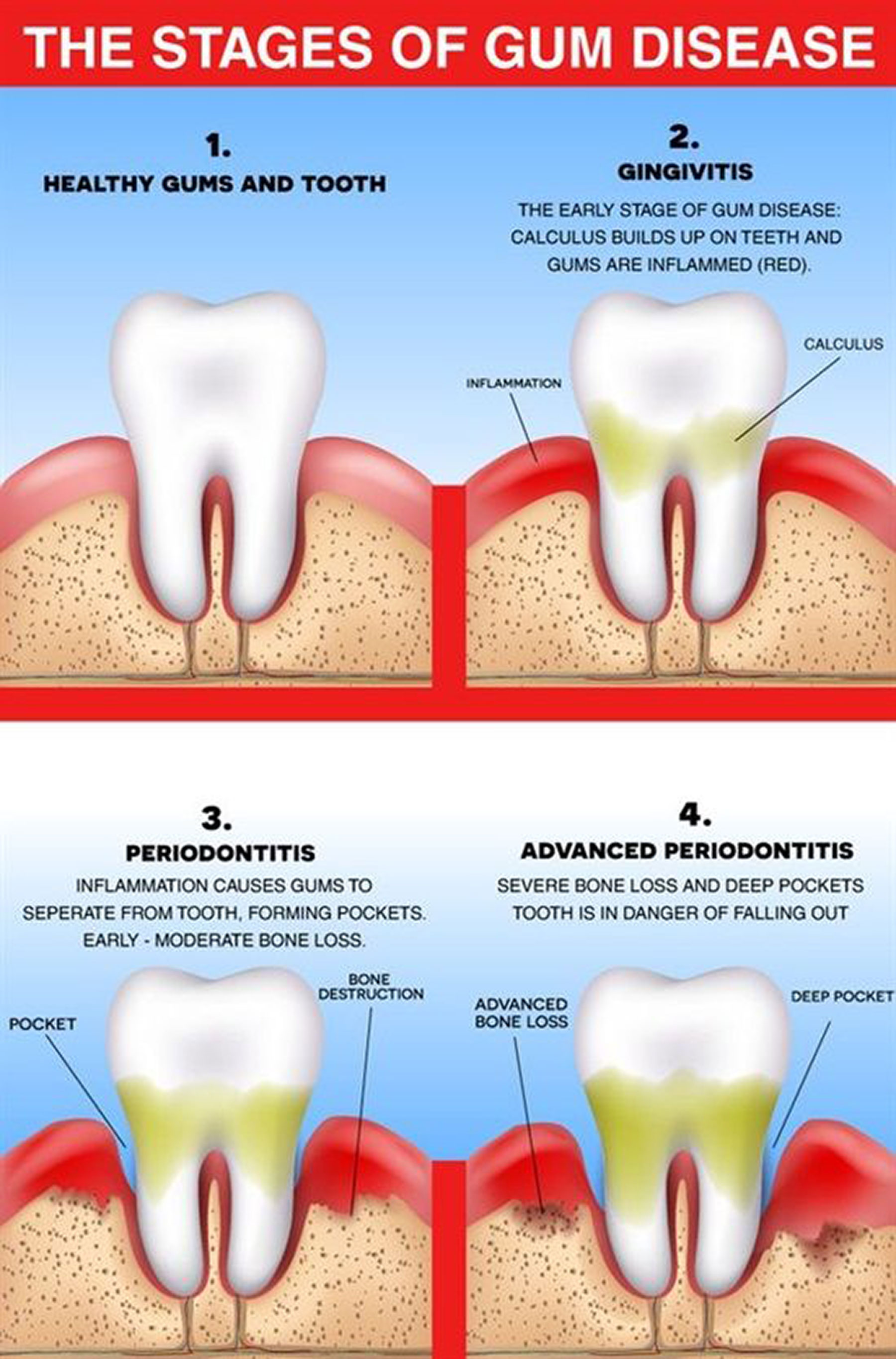 kim-okamura-steps-involved-in-gum-disease